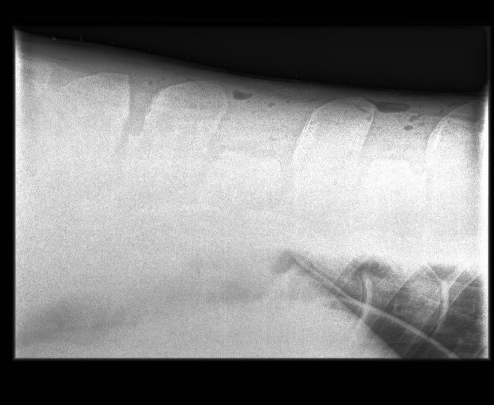 Kissing Spines Before And After Xrays