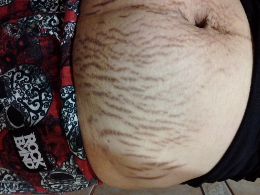 the real stretch marks ugh babycenter the real stretch marks ugh babycenter